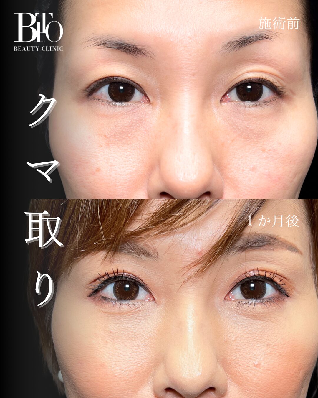 160.切らないクマ取り(脱脂術)