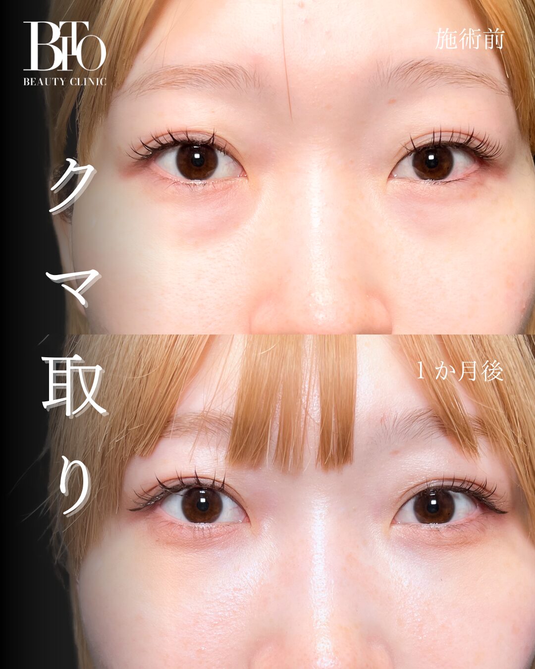 161.切らないクマ取り(脱脂術)