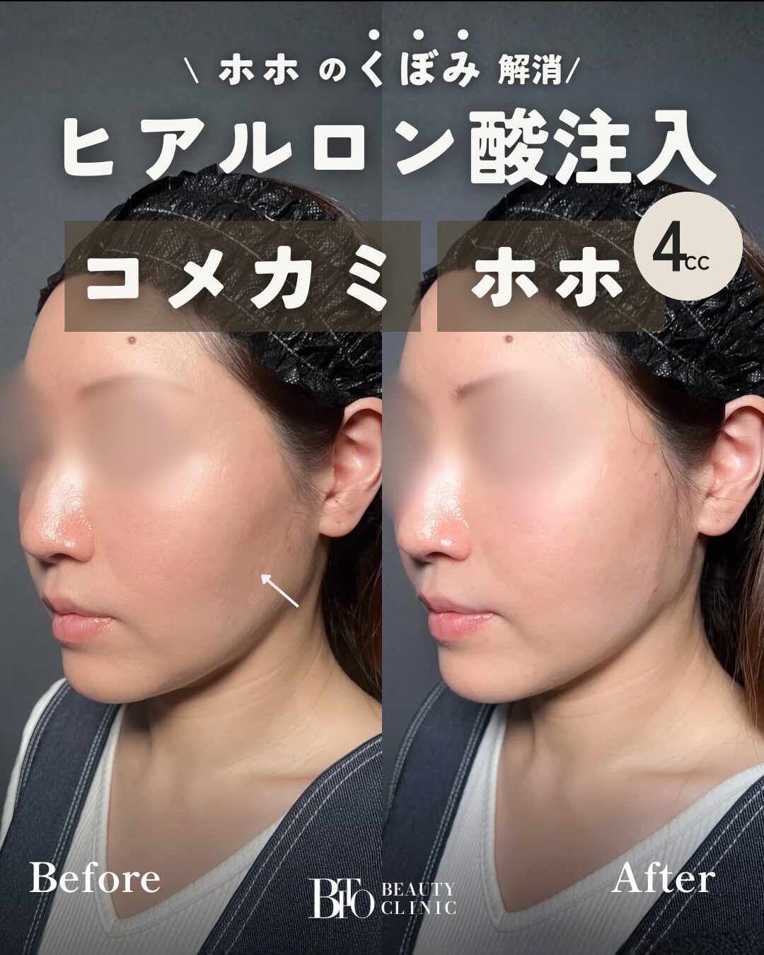 155.ヒアルロン酸注入