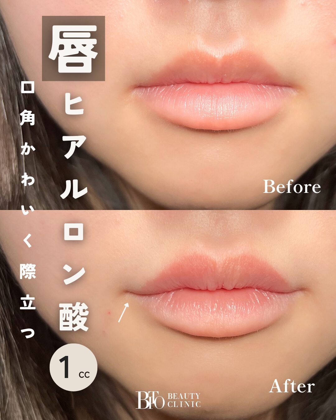 166.ヒアルロン酸