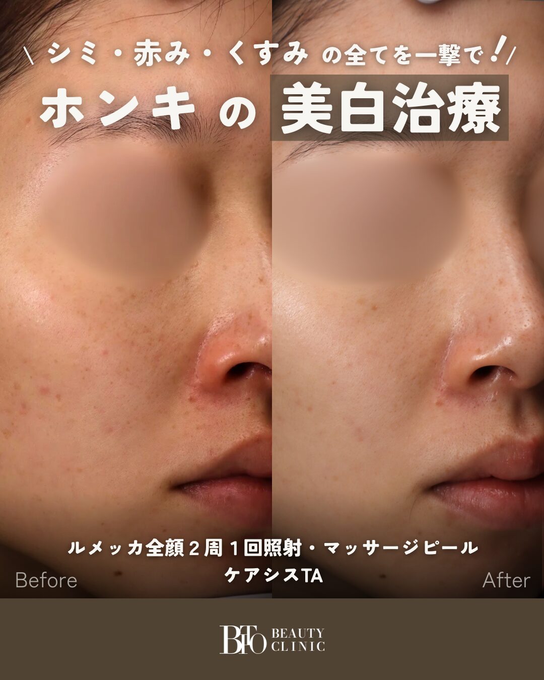 162.ルメッカ全顔２周１回照射・マッサージピール・ケアシスTA