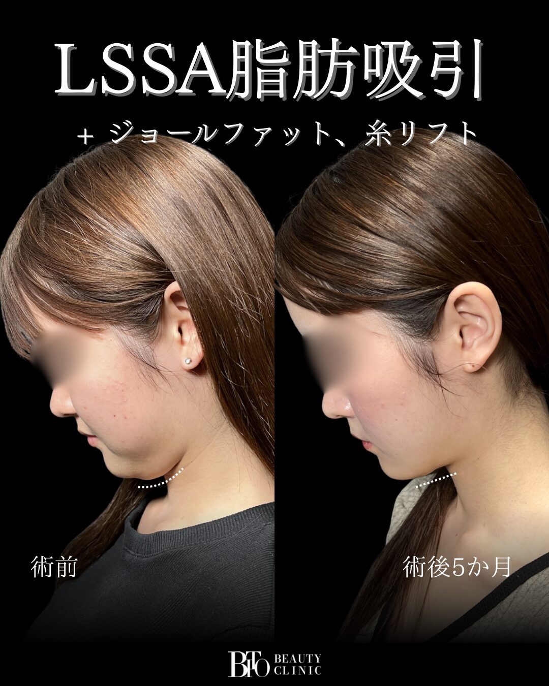 170.20代女性 顔の脂肪吸引