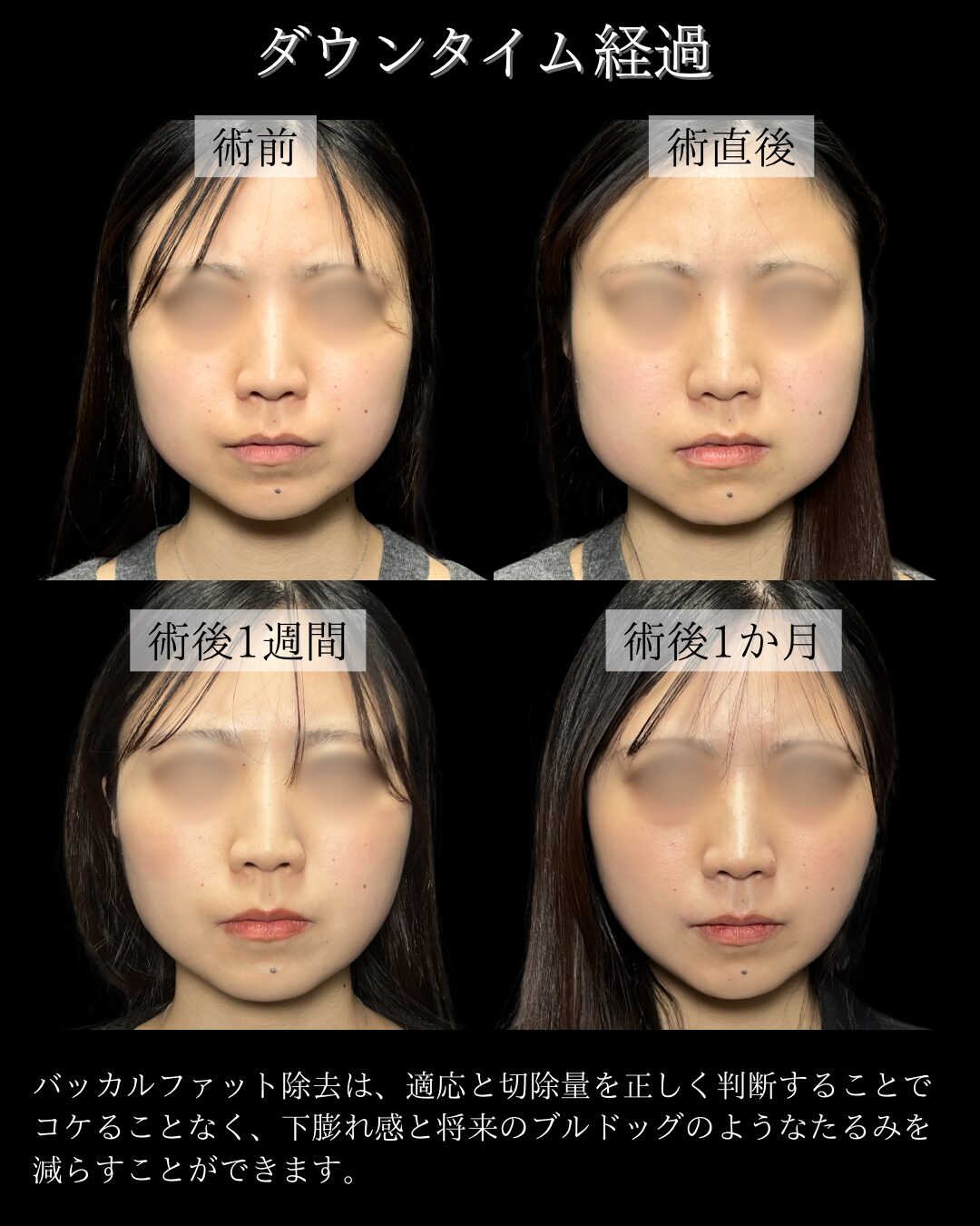 バッカルファット除去