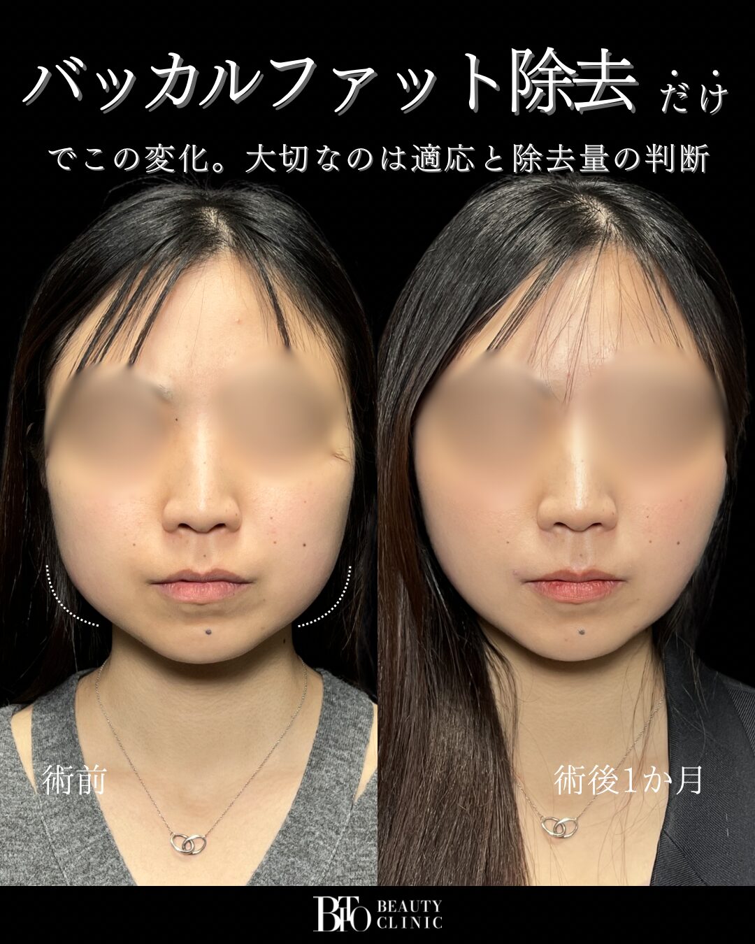 171.20代女性 バッカルファット除去