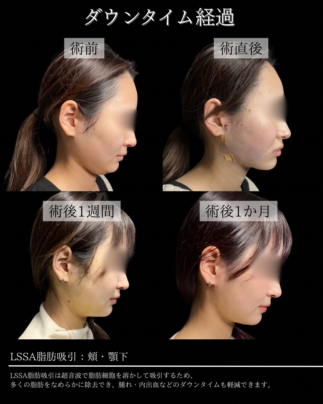 172. 20代女性 顔のLSSA脂肪吸引