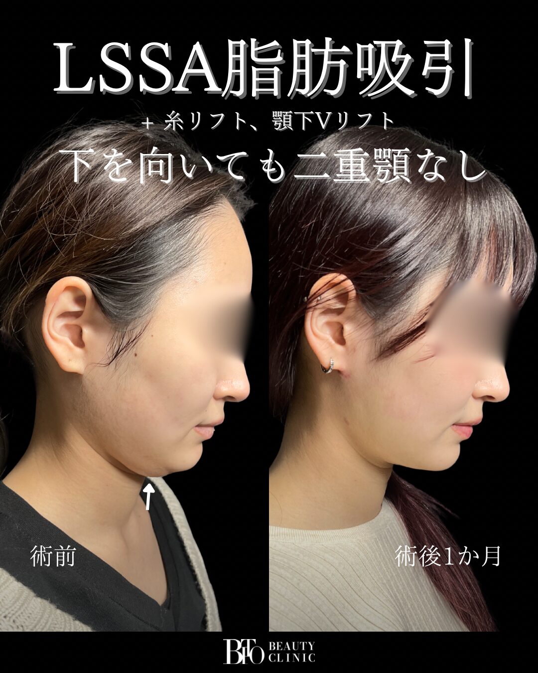 172. 20代女性 顔のLSSA脂肪吸引