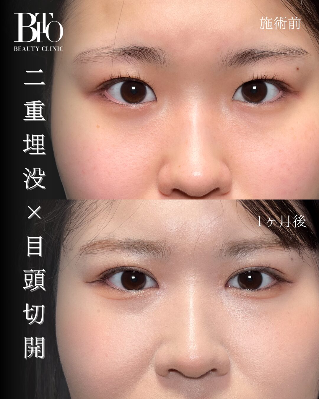 183.二重埋没法・目頭切開