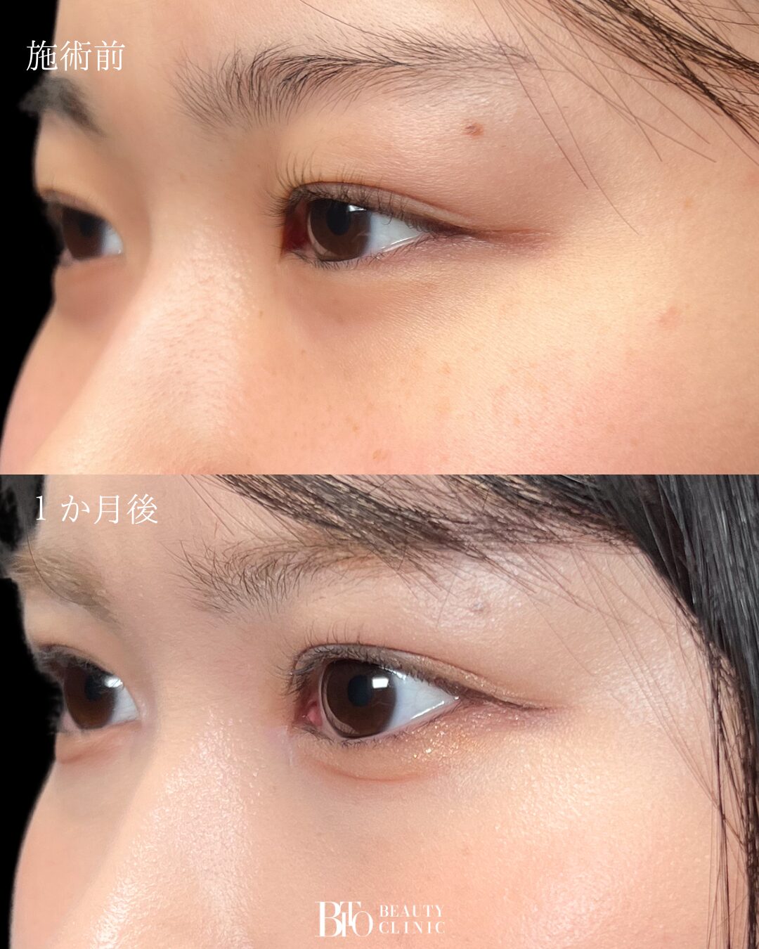 183.二重埋没法・目頭切開