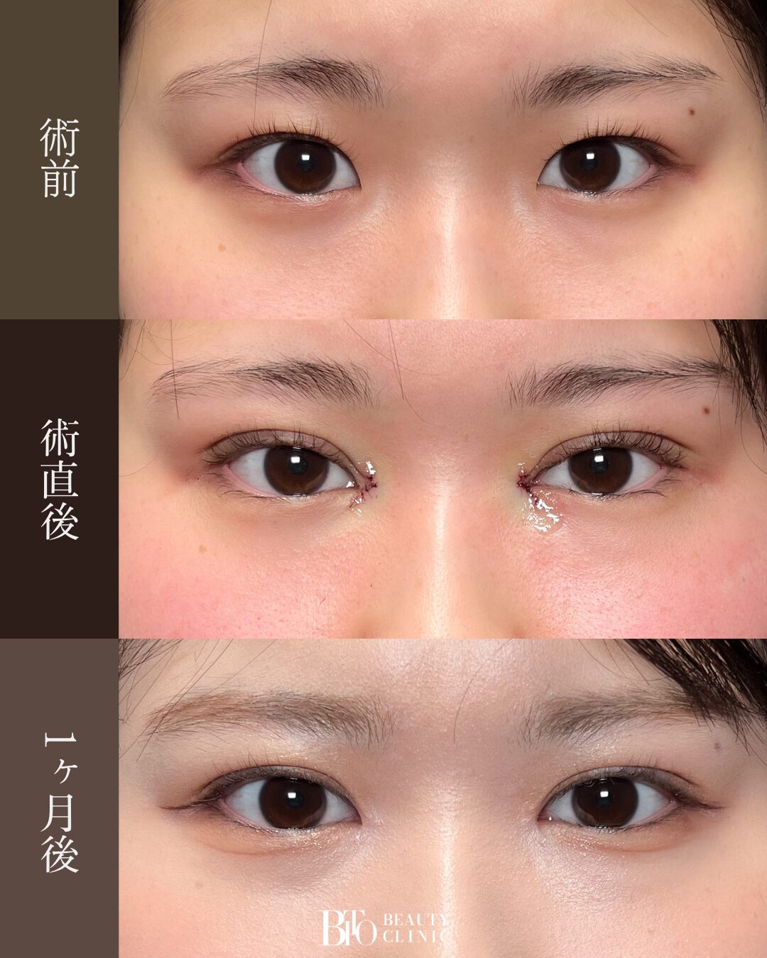 183.二重埋没法・目頭切開