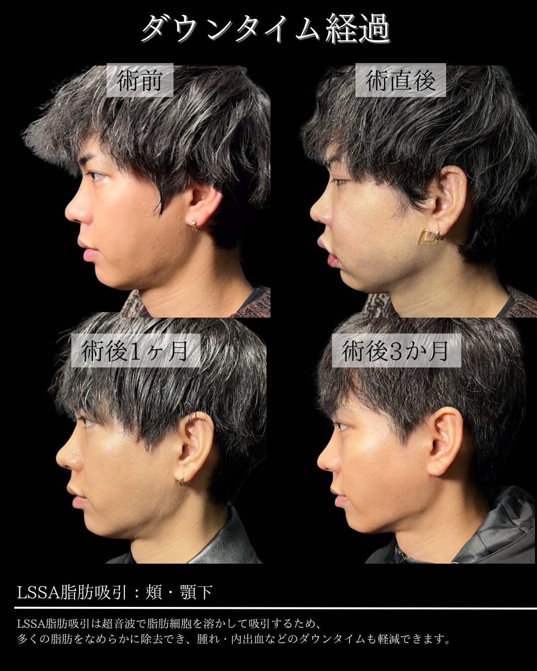 180.30代男性 顔のLSSA脂肪吸引