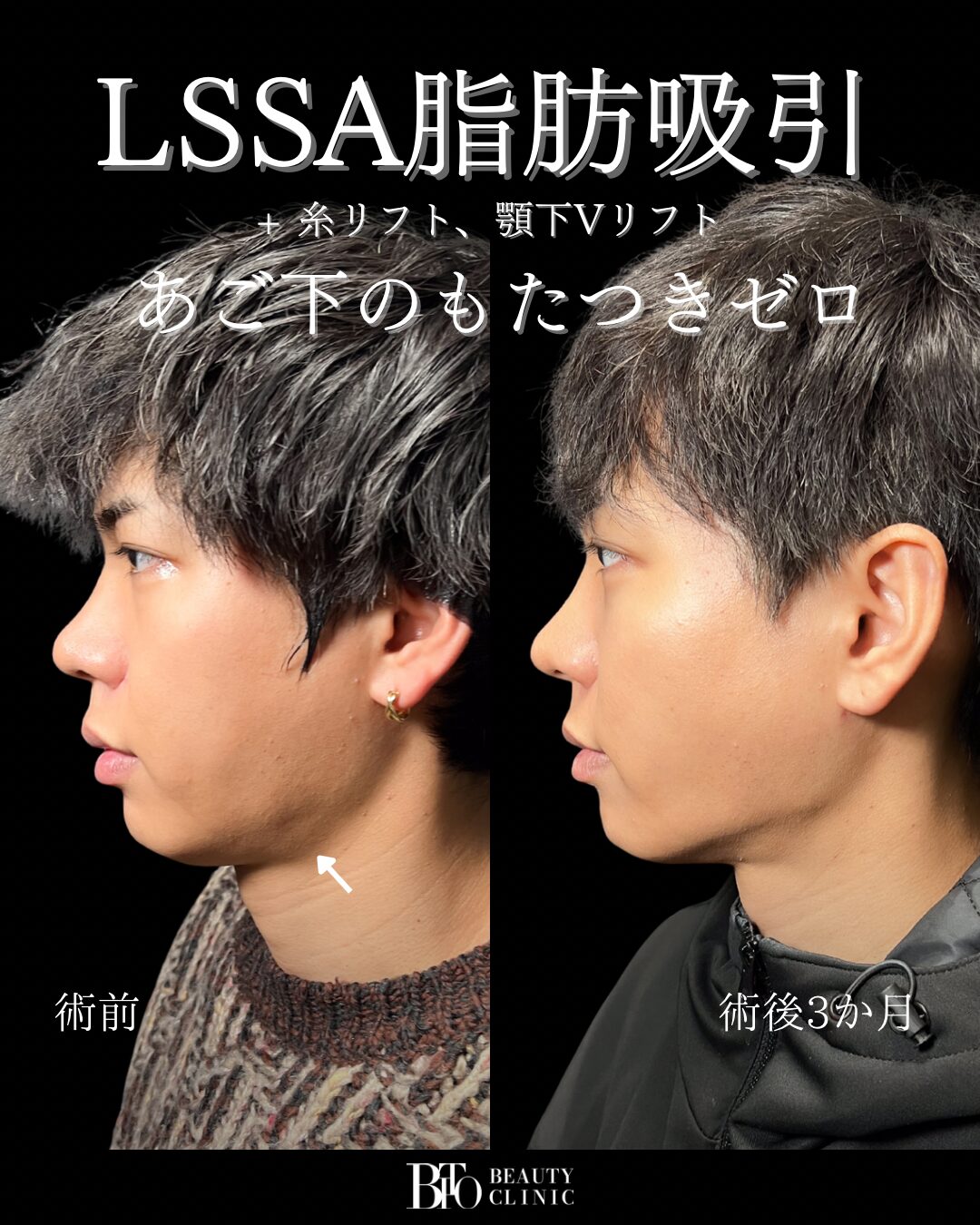 180.30代男性 顔のLSSA脂肪吸引