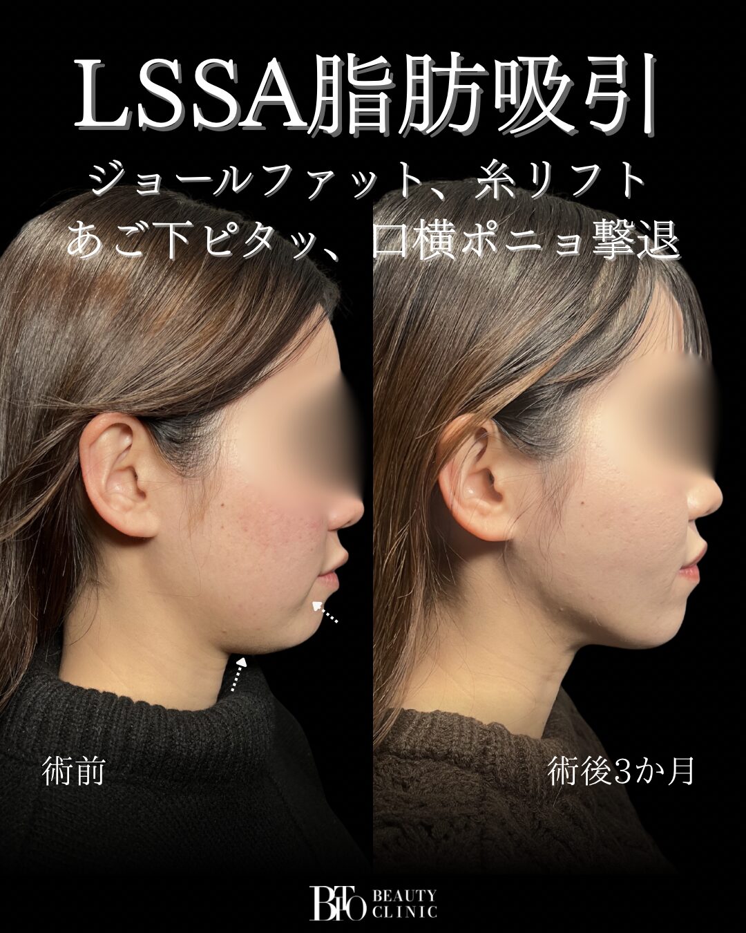 189.20代女性 顔のLSSA脂肪吸引・ジョールファット除去・糸リフト