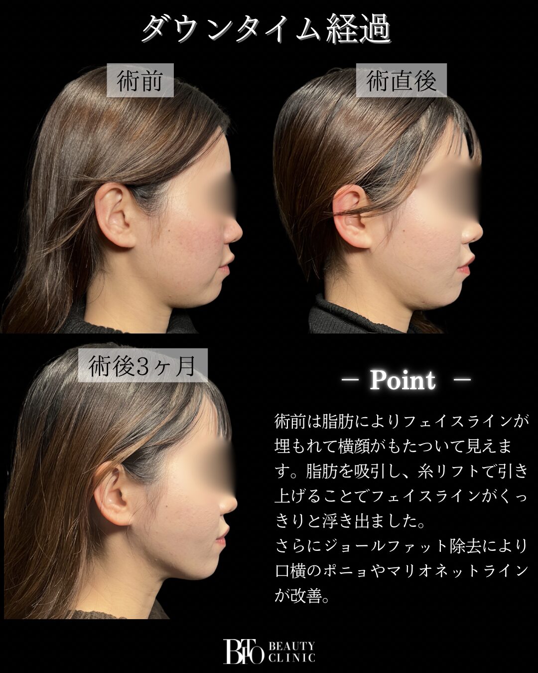 189.20代女性 顔のLSSA脂肪吸引・ジョールファット除去・糸リフト