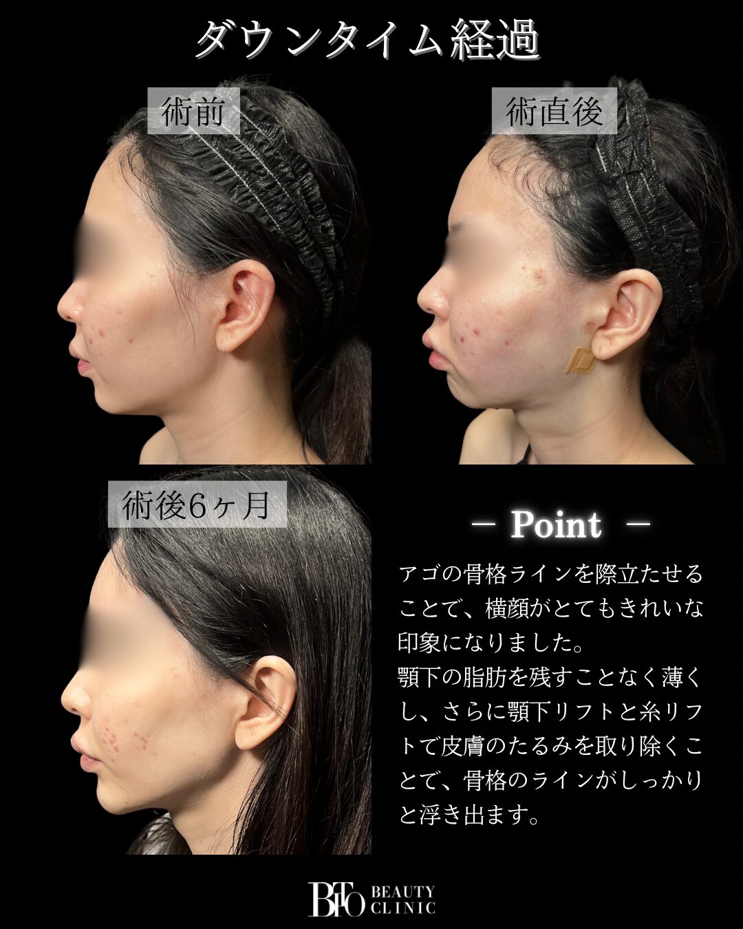 200.20代女性 顔のLSSA脂肪吸引