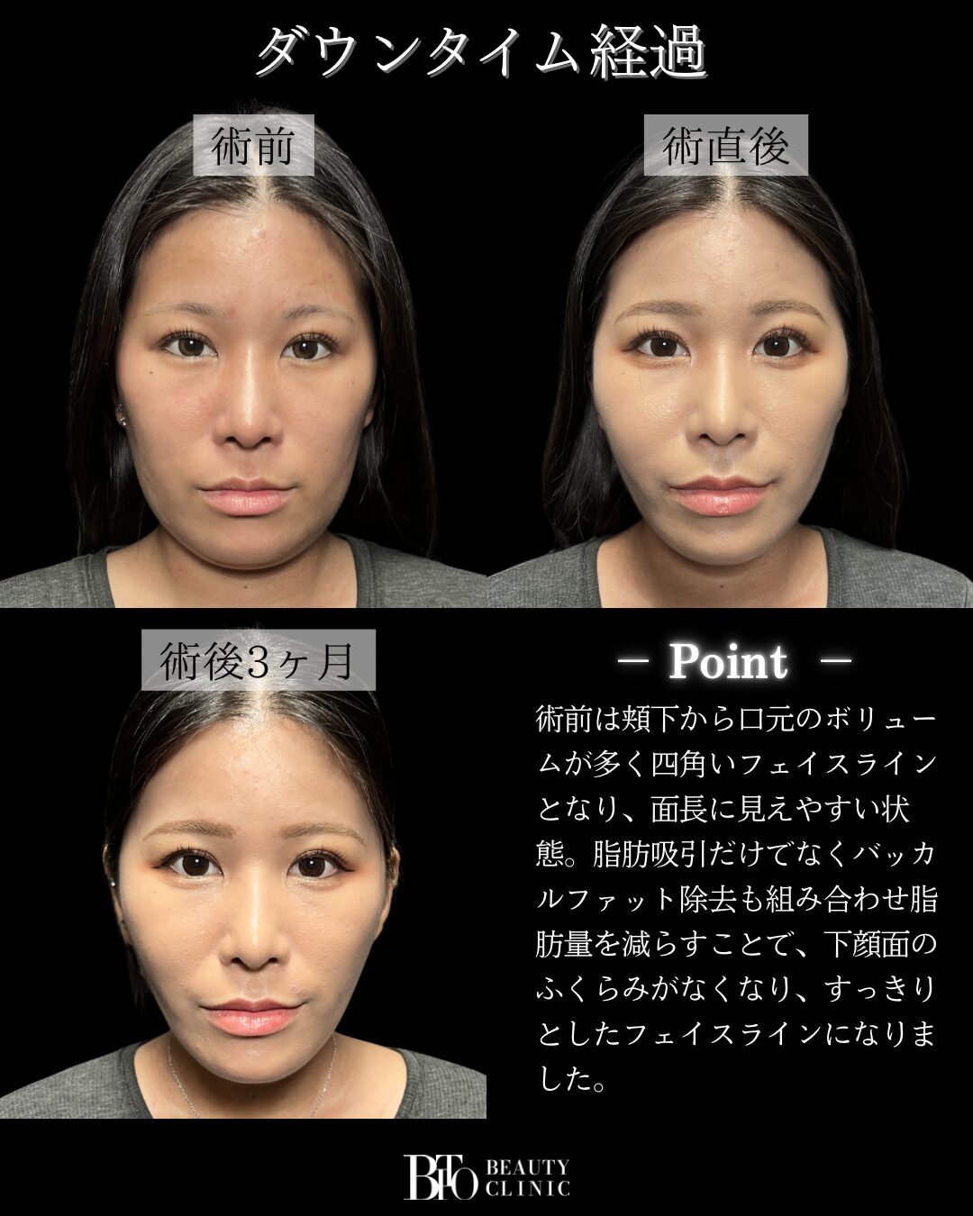 20代女性 顔のLSSA脂肪吸引・バッカルファット除去・糸リフト