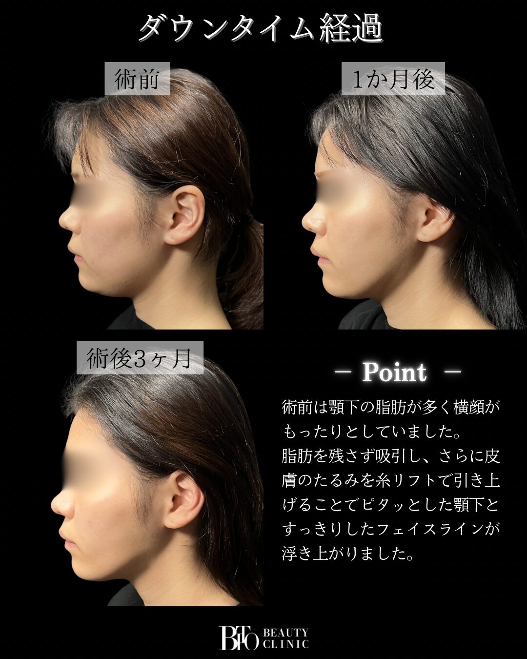 20代女性 顔のLSSA脂肪吸引・顎下Vリフト・糸リフト