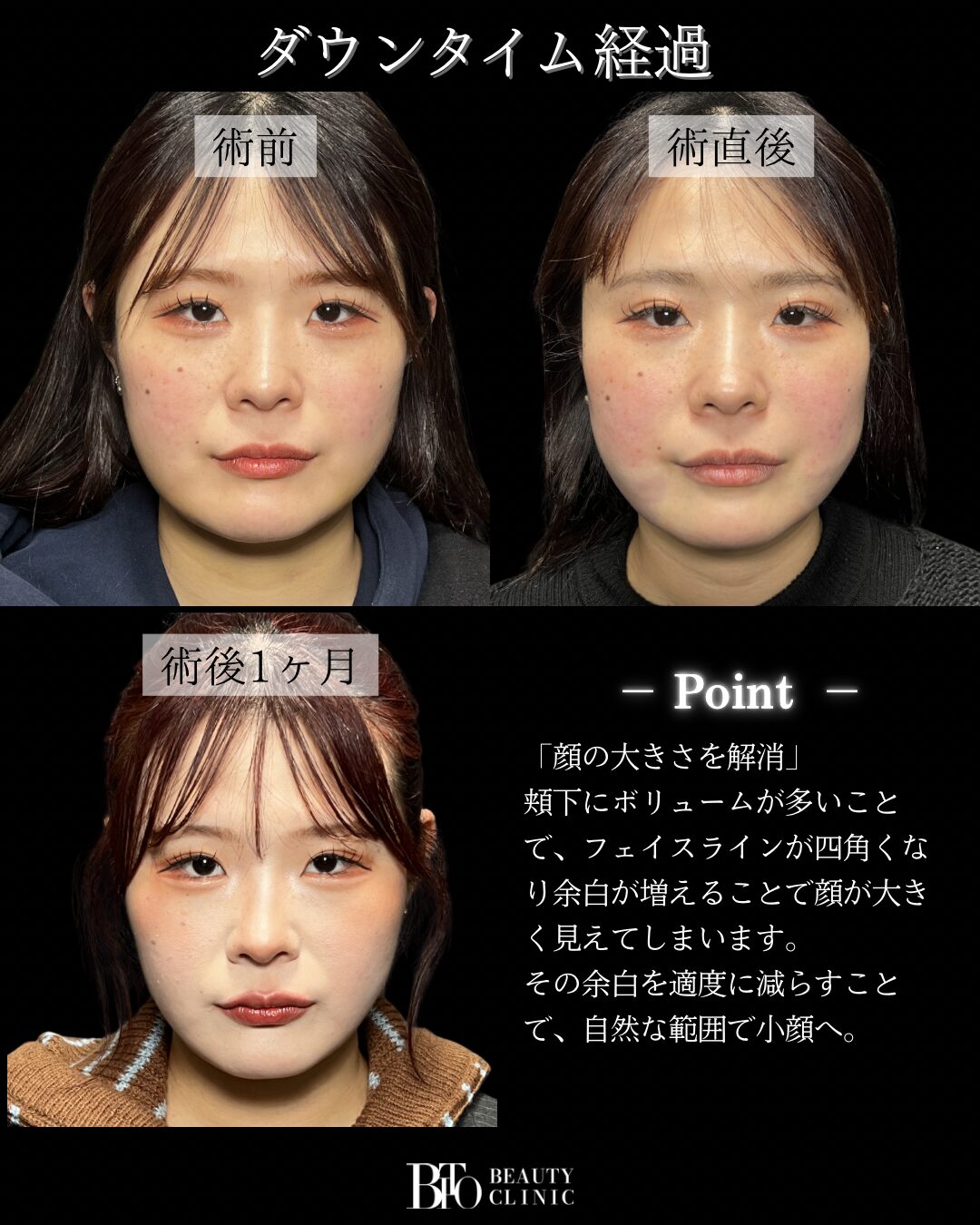 185.LSSA脂肪吸引