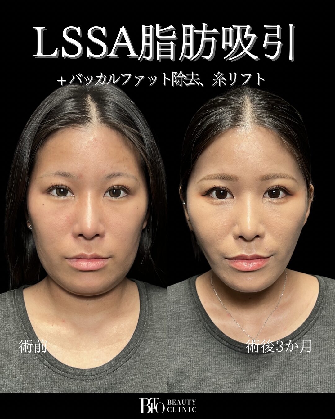 20代女性 顔のLSSA脂肪吸引・バッカルファット除去・糸リフト