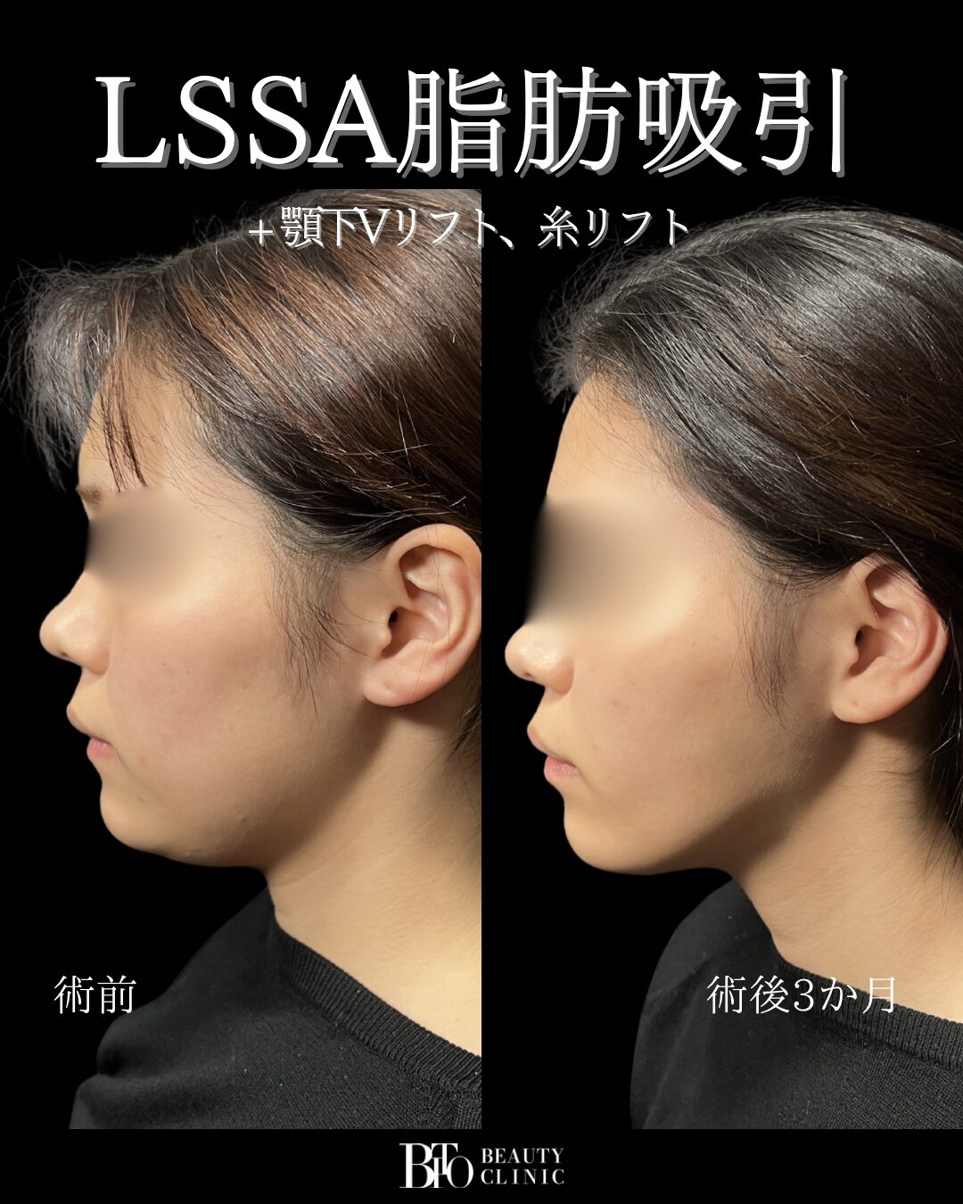 20代女性 顔のLSSA脂肪吸引・顎下Vリフト・糸リフト