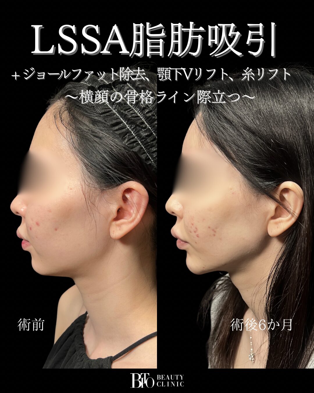 200.20代女性 顔のLSSA脂肪吸引