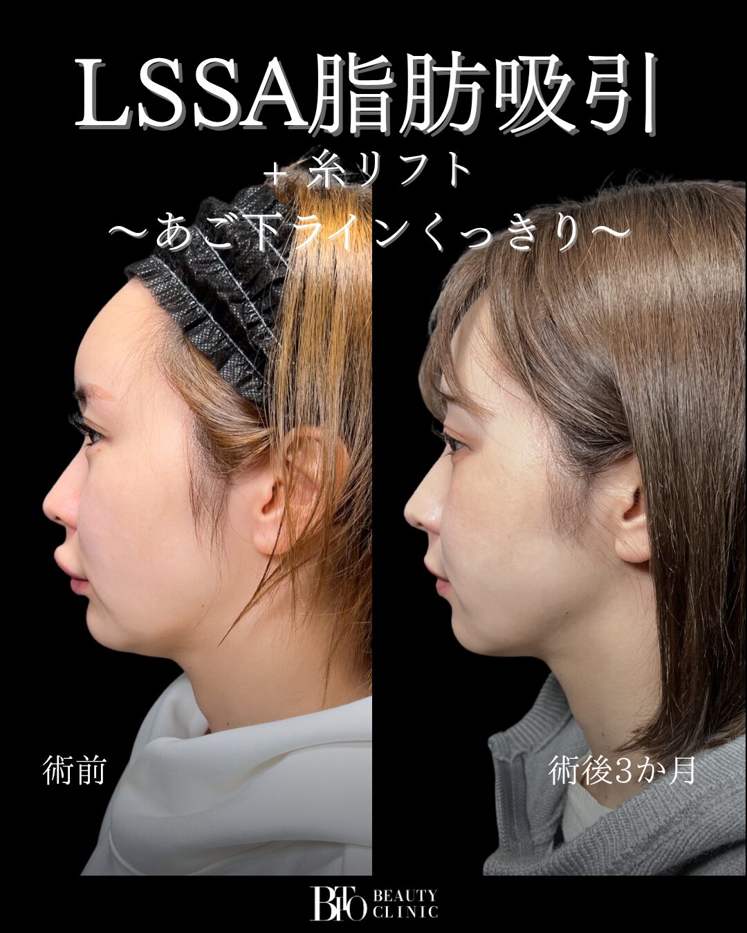 199.20代女性 顔のLSSA脂肪吸引
