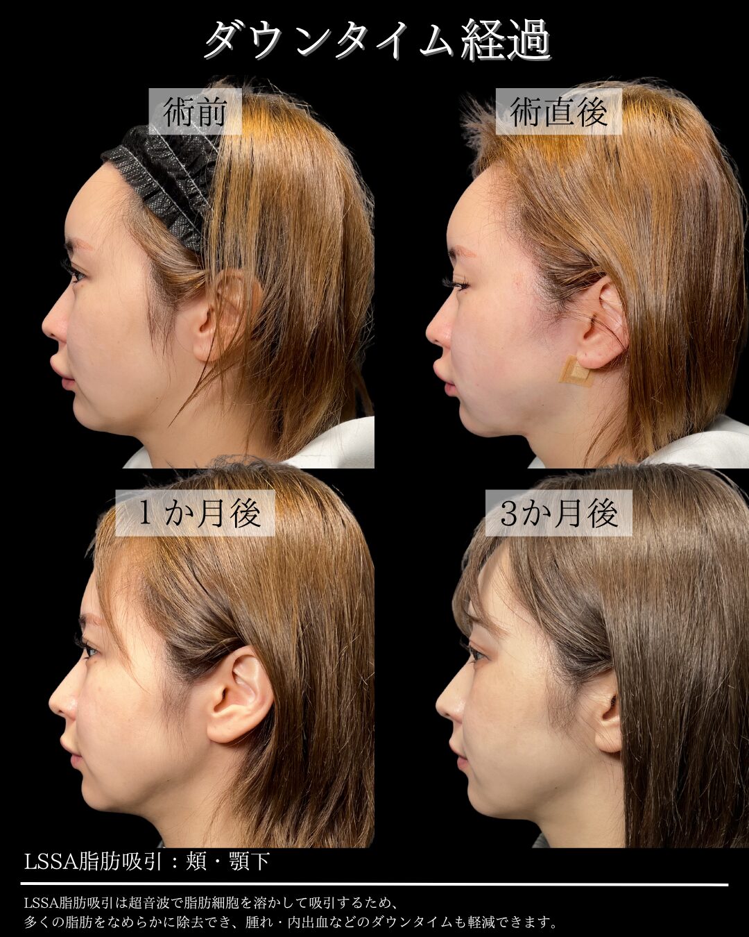 199.20代女性 顔のLSSA脂肪吸引