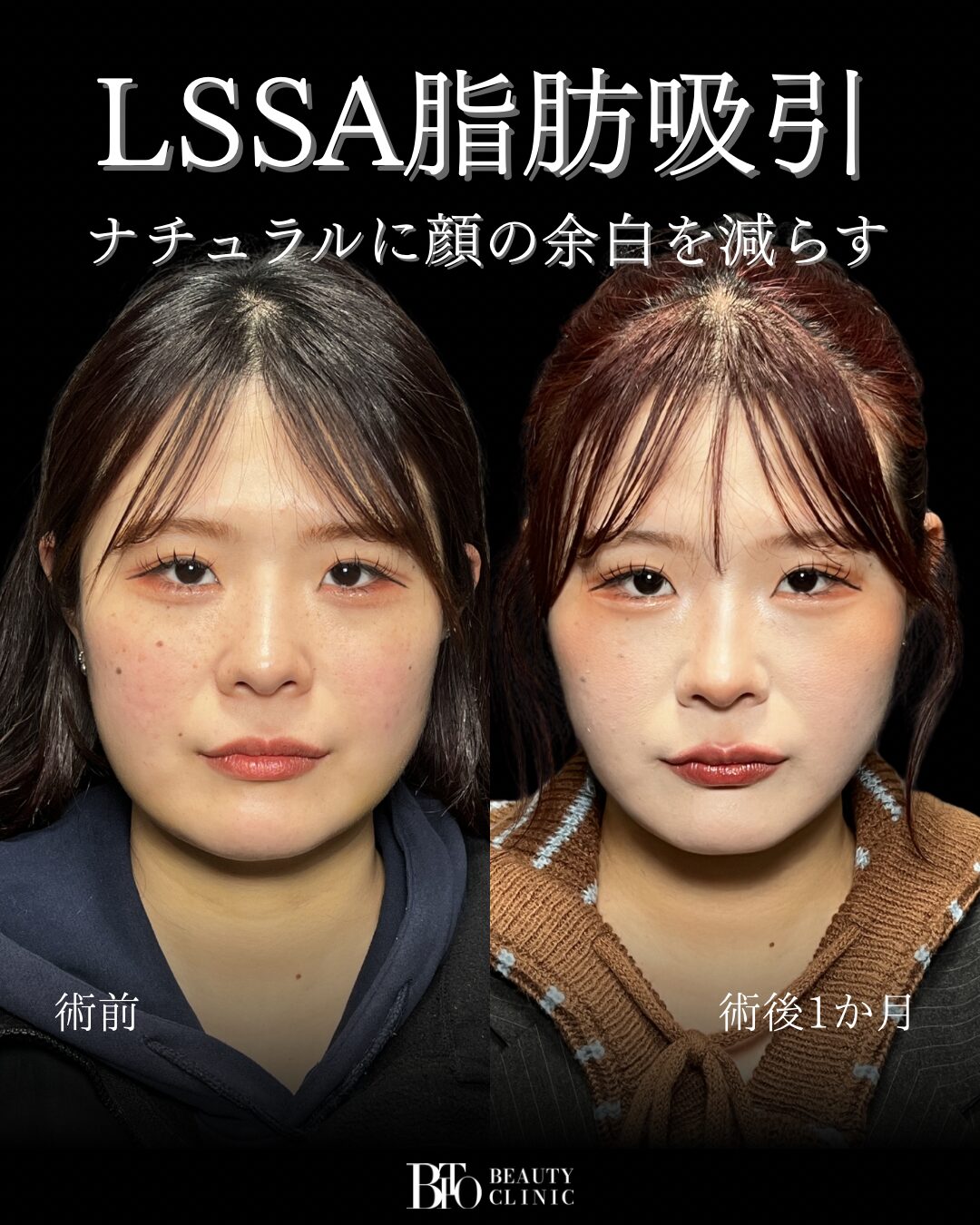 185.LSSA脂肪吸引