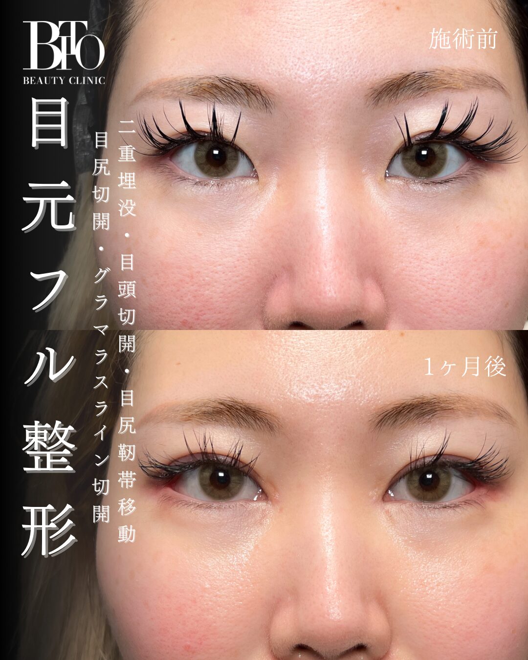 191.目元フル整形