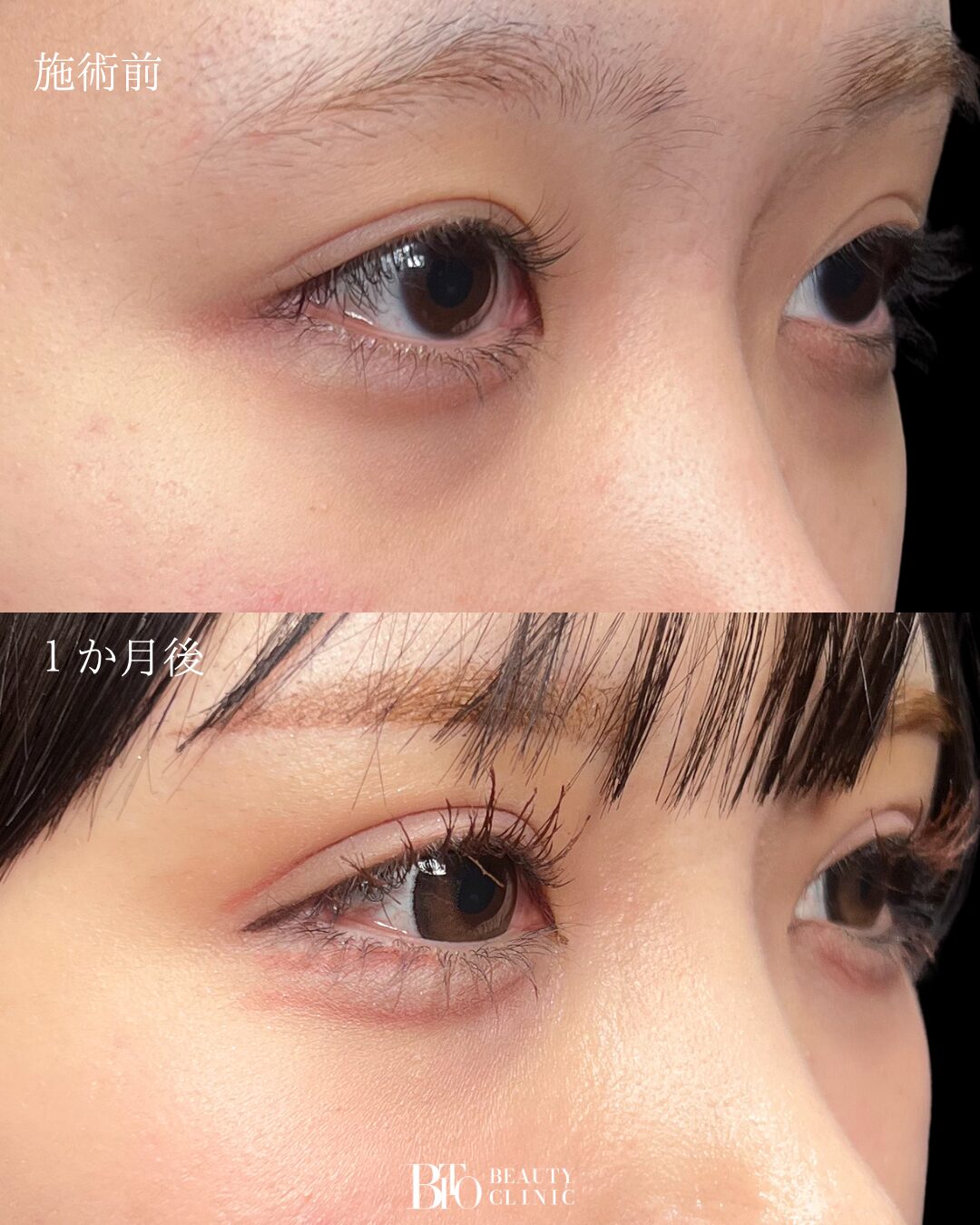 197.20代女性 二重埋没法