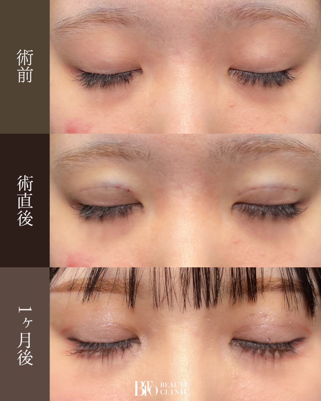 196.10代女性 二重埋没法・目頭切開