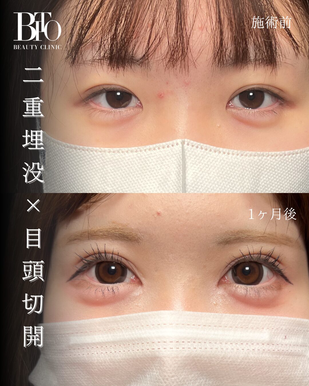 196.10代女性 二重埋没法・目頭切開