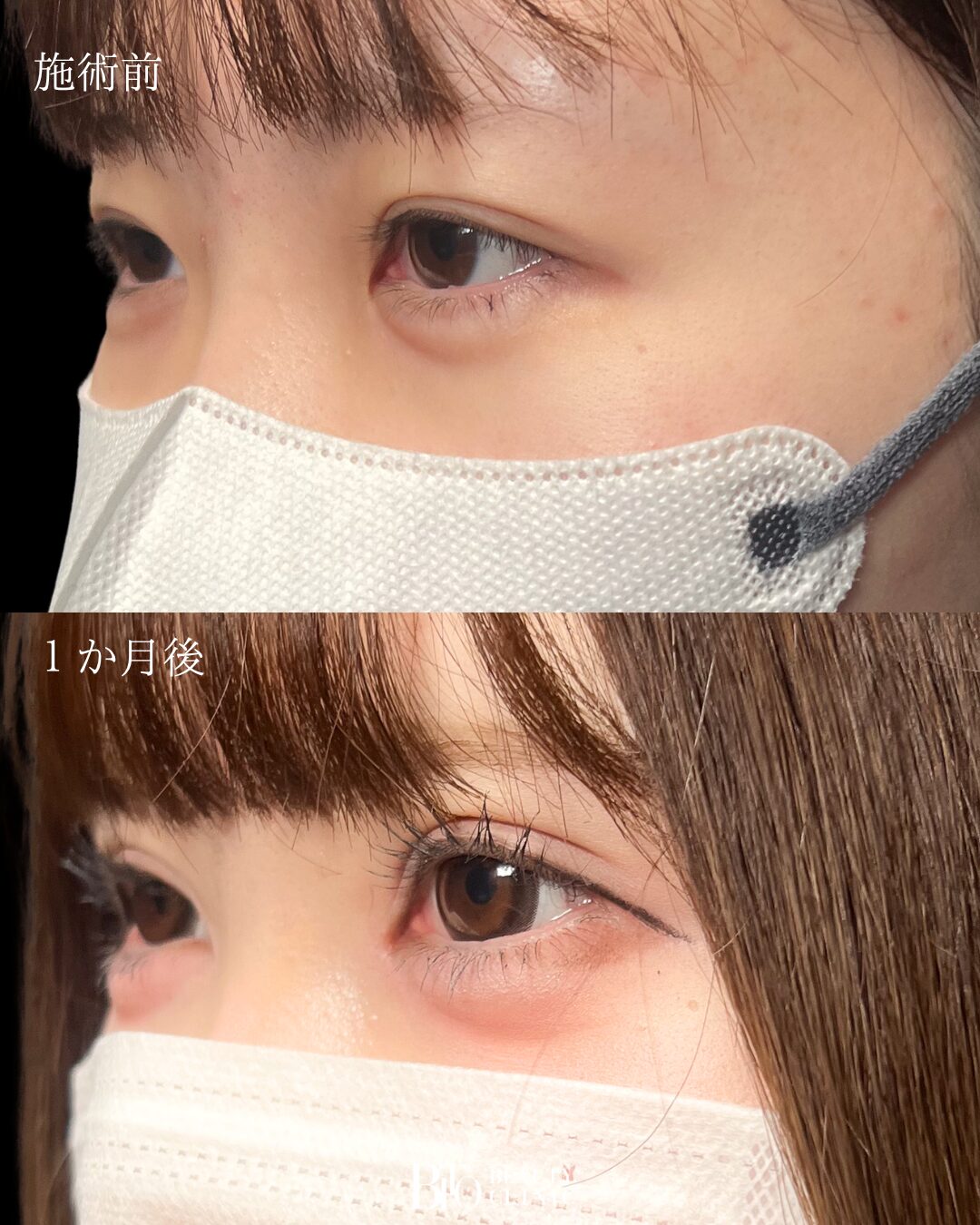 196.10代女性 二重埋没法・目頭切開