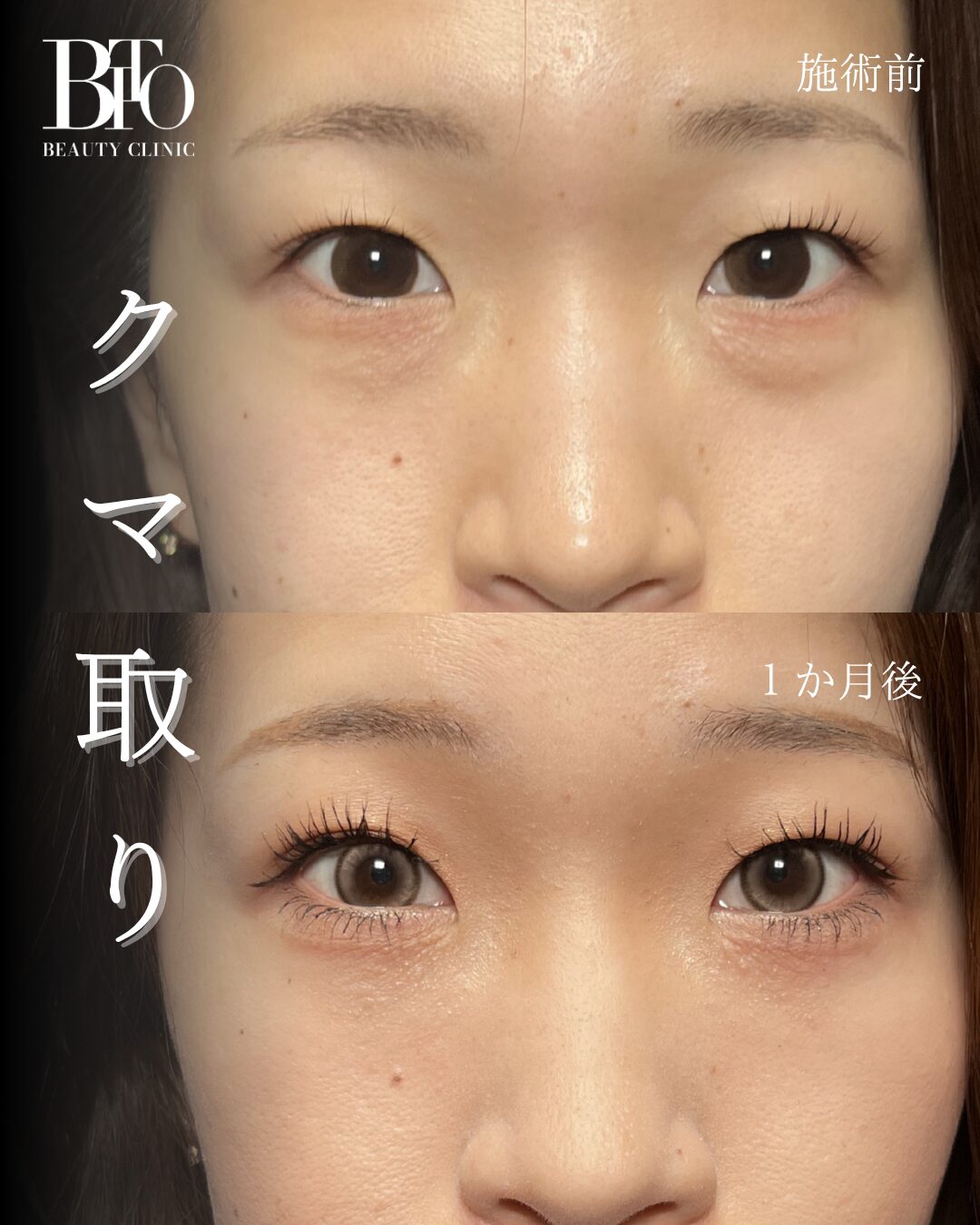 20代女性 切らないクマ取り(脱脂術)