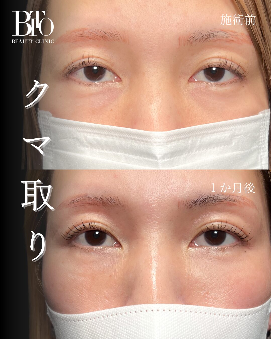 198.40代女性 切らないクマ取り(脱脂術)