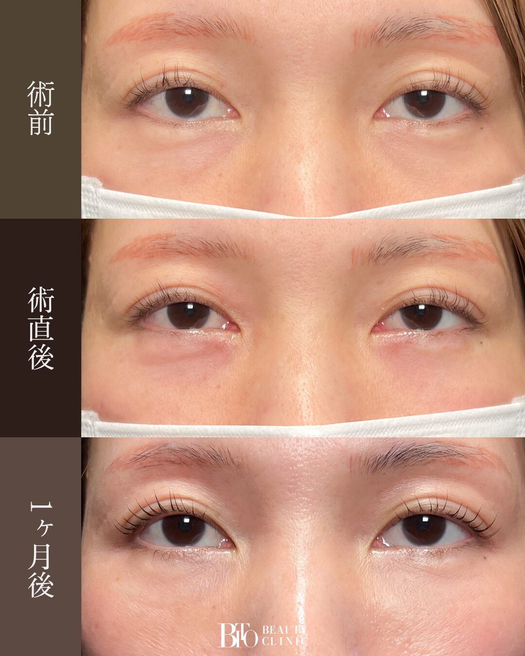 198.40代女性 切らないクマ取り(脱脂術)