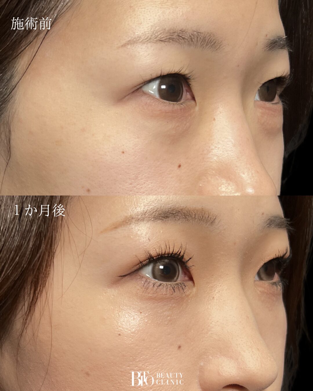 20代女性 切らないクマ取り(脱脂術)