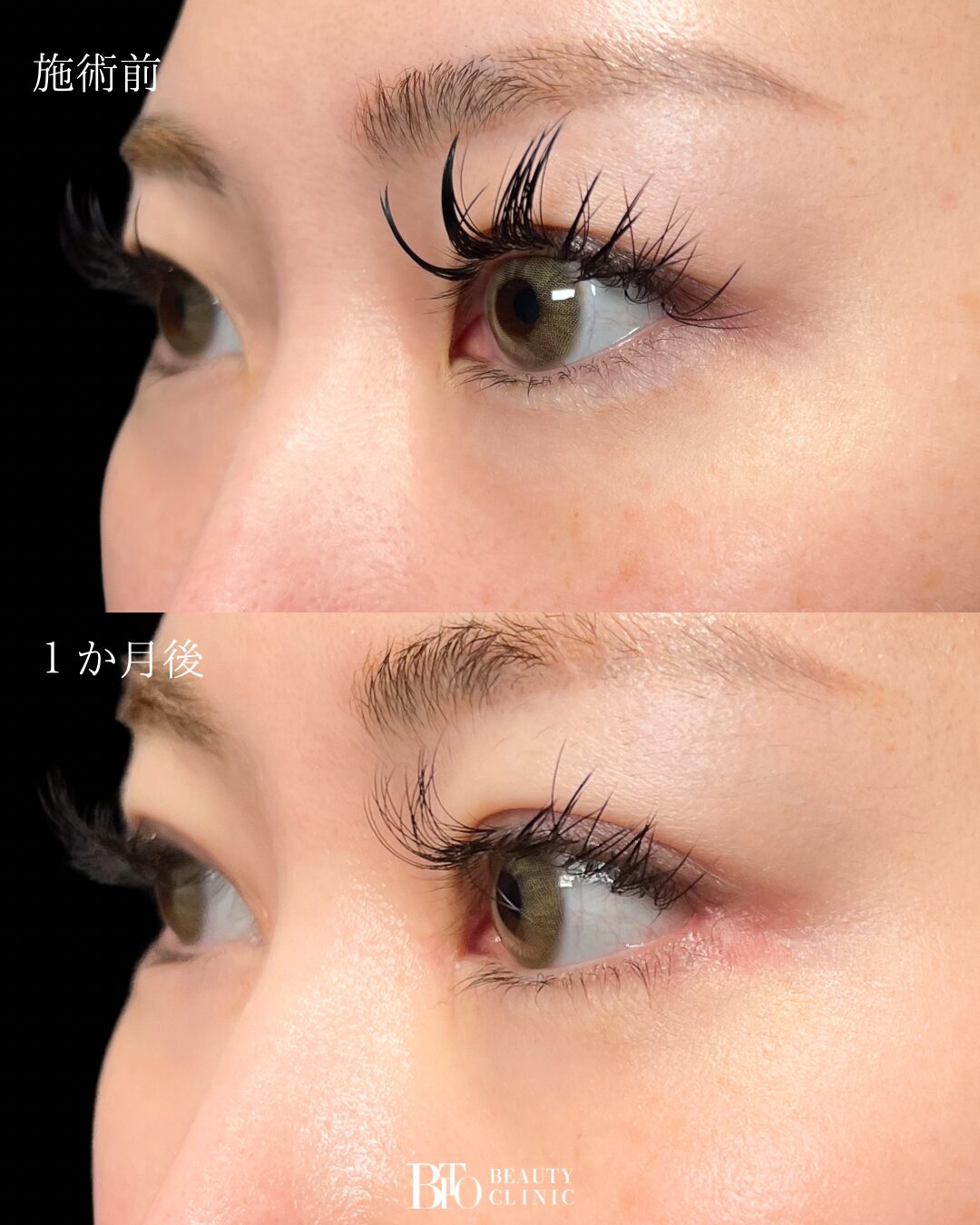 191.目元フル整形