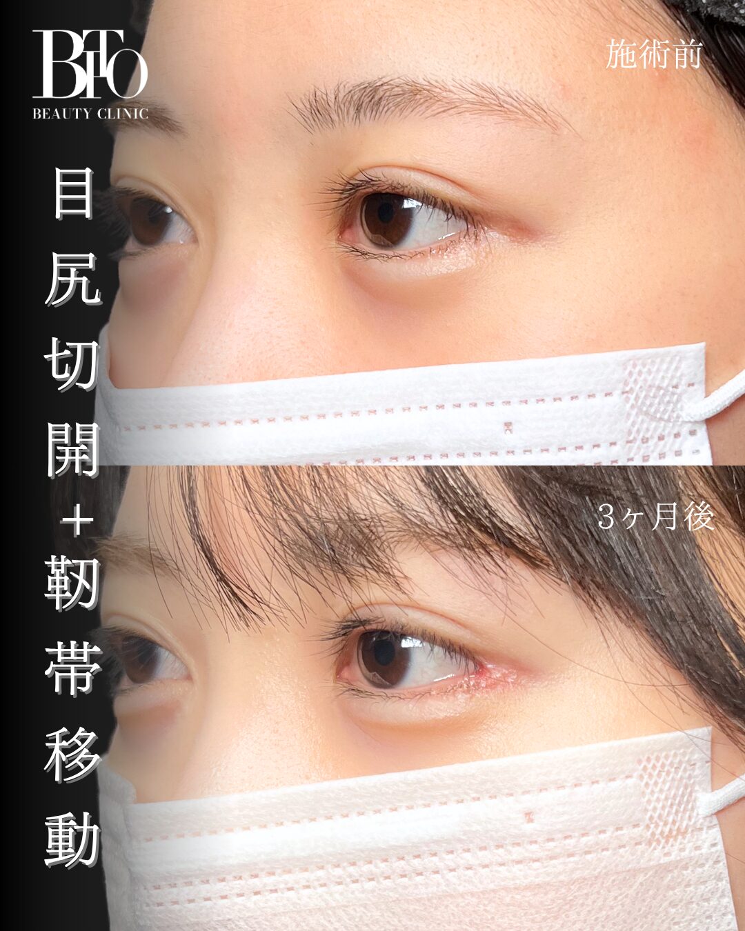 194.目尻切開+目尻靭帯移動