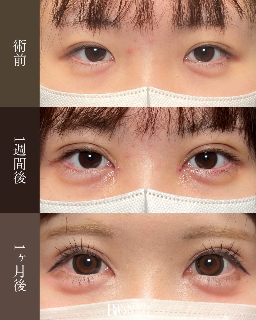 186.20代女性 二重埋没・目頭切開