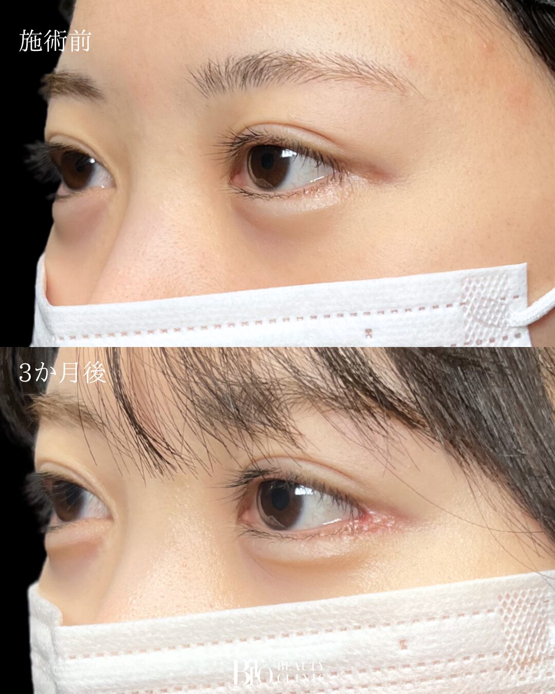 194.目尻切開+目尻靭帯移動