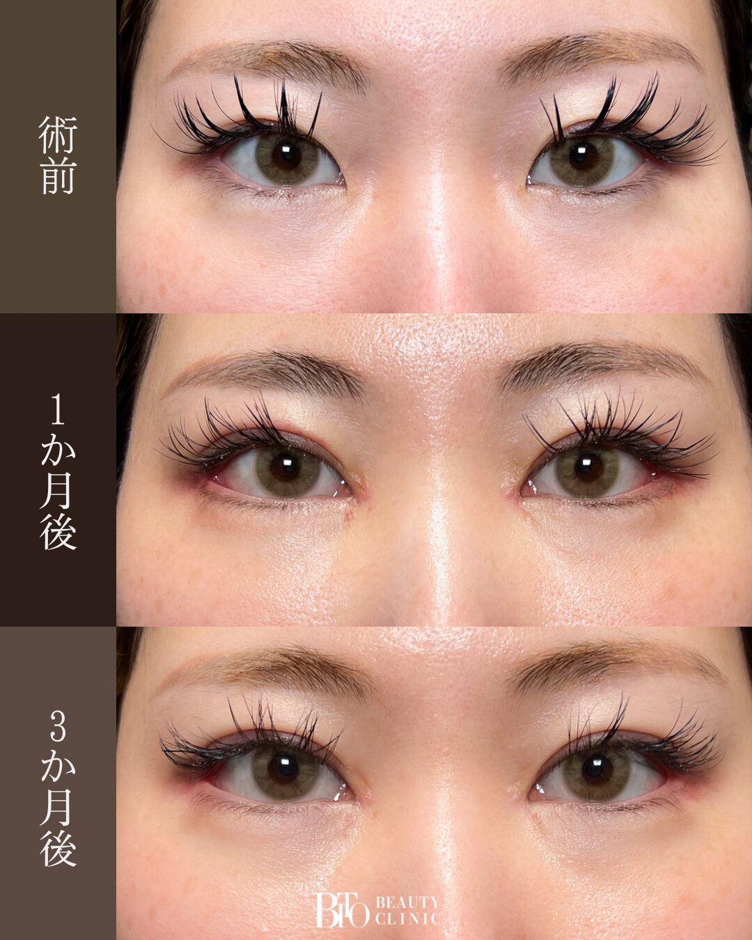 191.目元フル整形