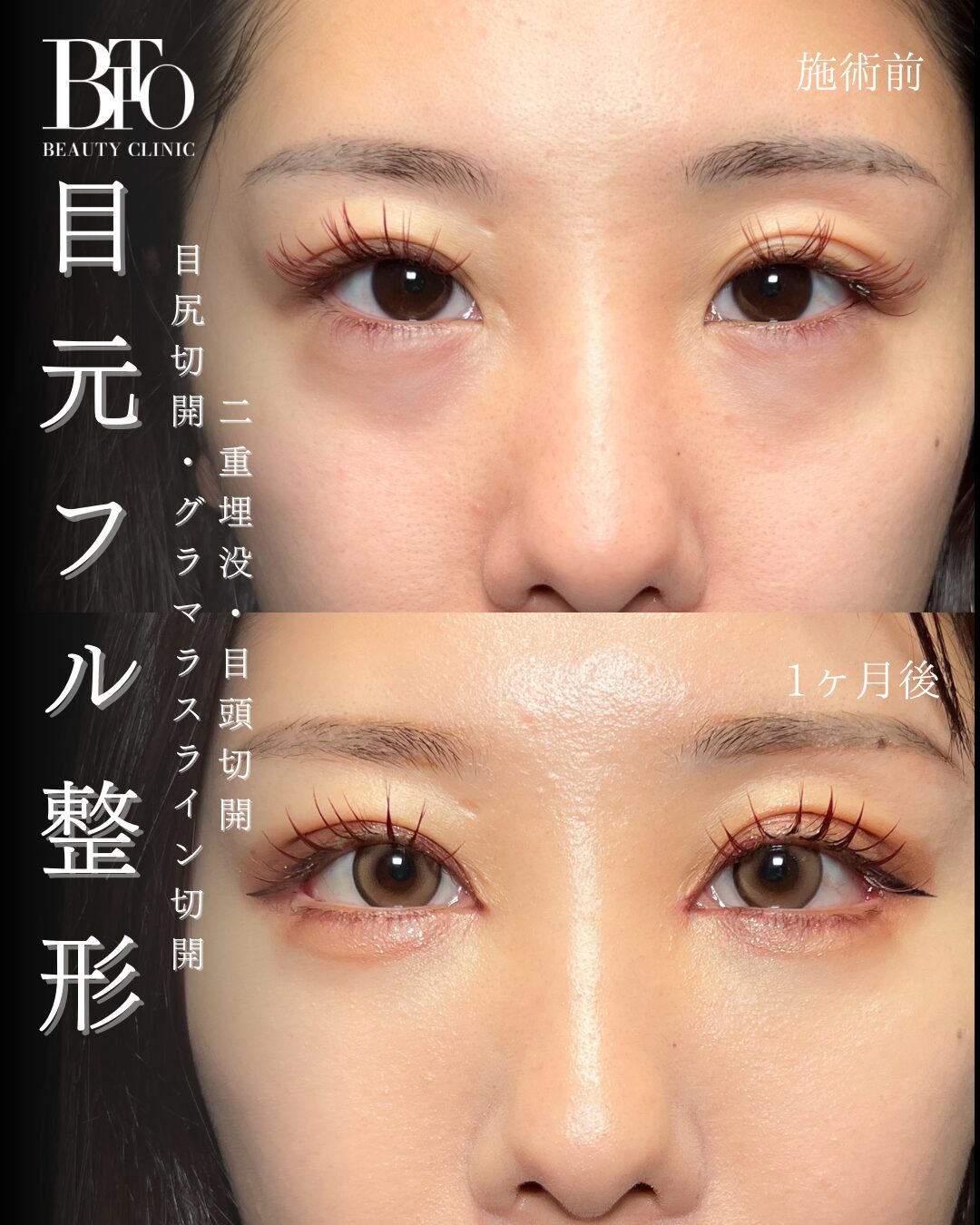 190. 目元フル整形