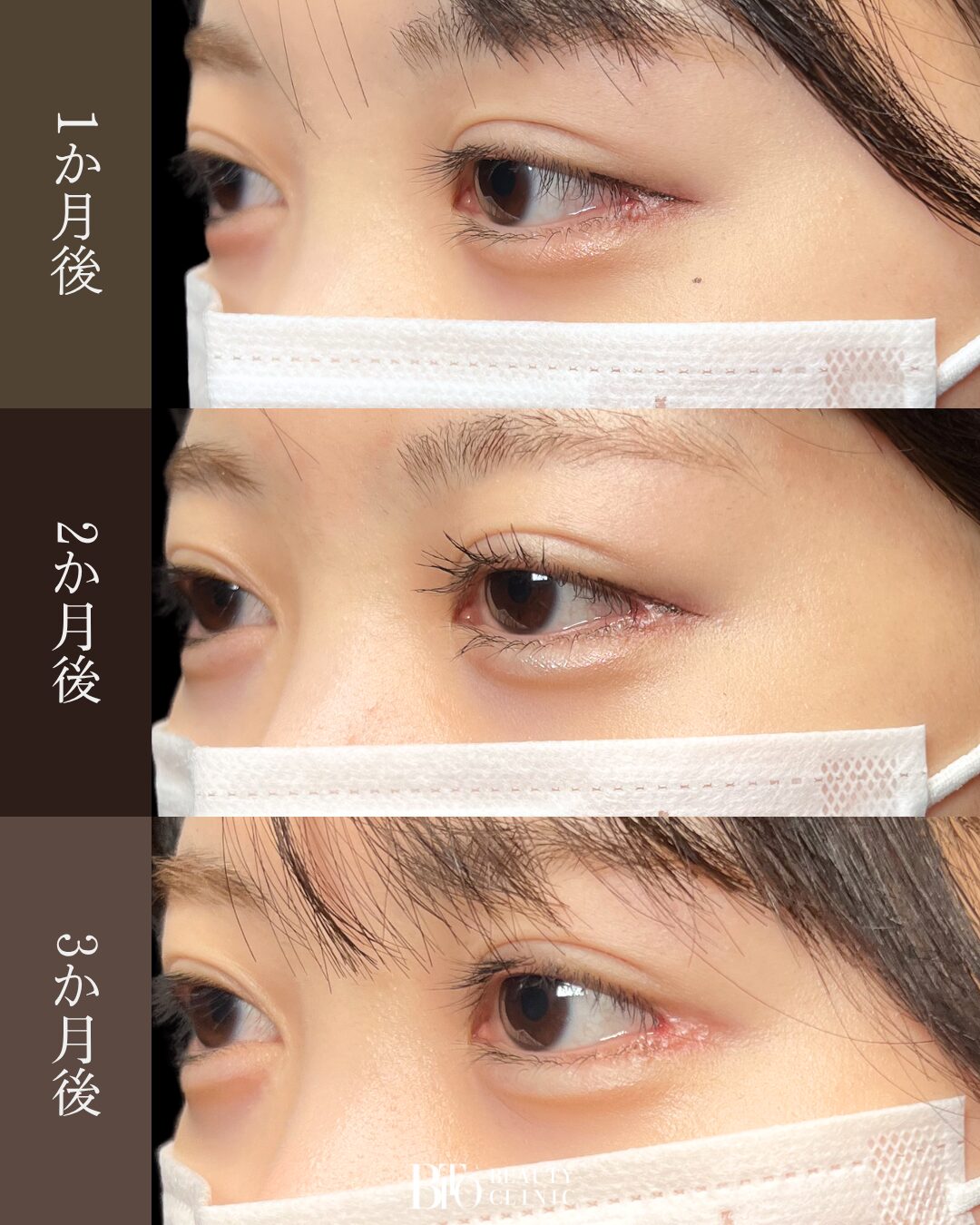 194.目尻切開+目尻靭帯移動