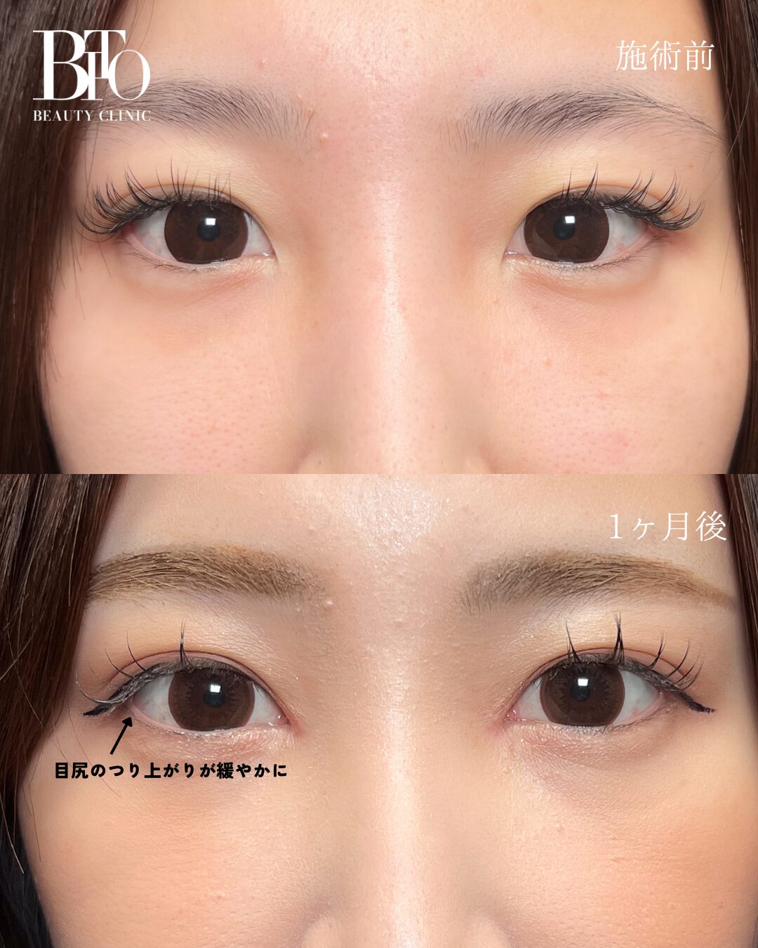 187.30代女性 グラマラスライン形成(埋没)