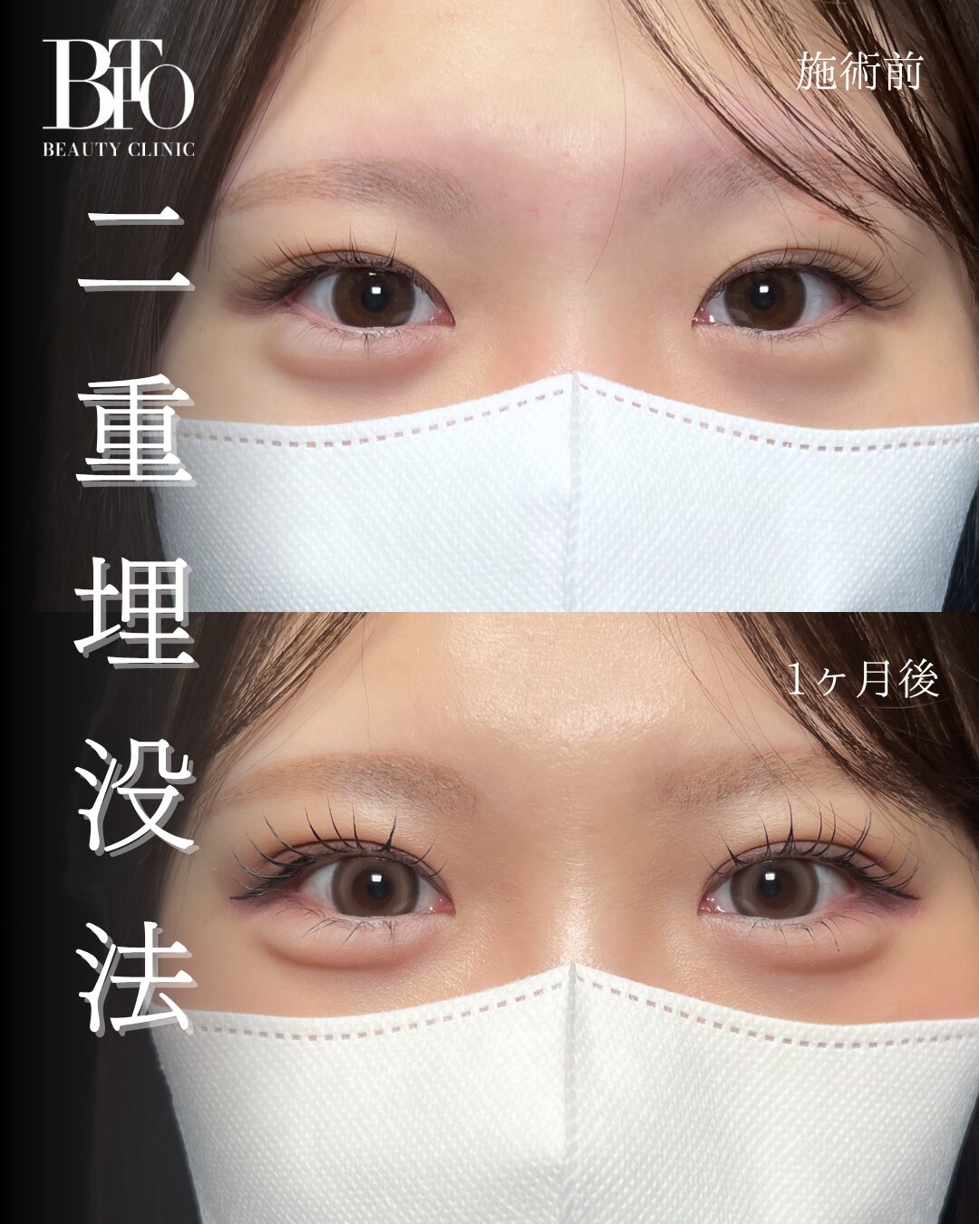 195.20代女性 二重埋没法