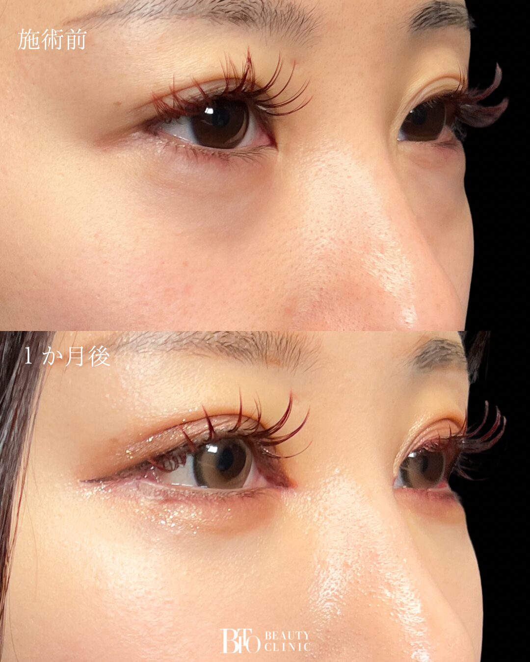 190. 目元フル整形