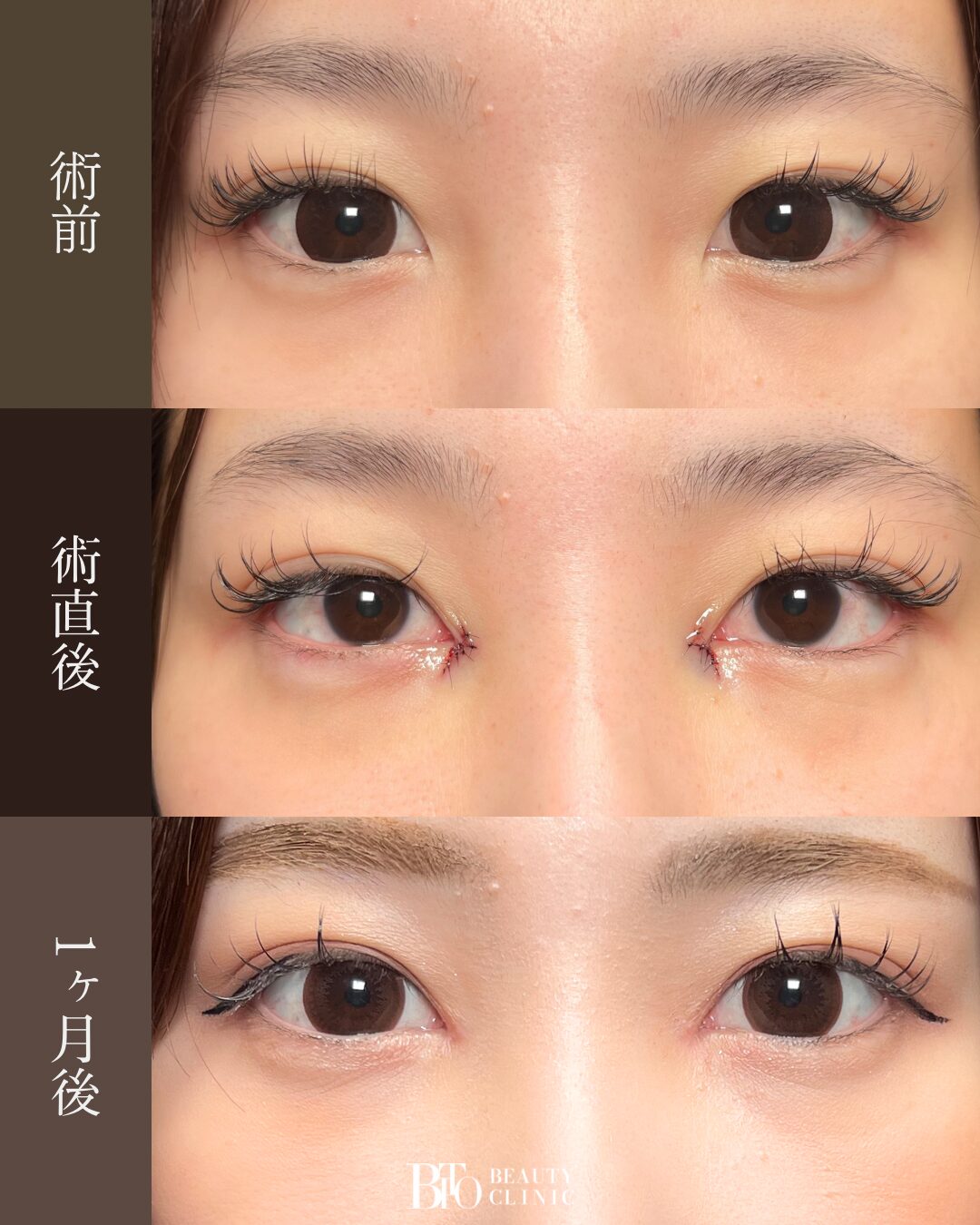 187.30代女性 グラマラスライン形成(埋没)