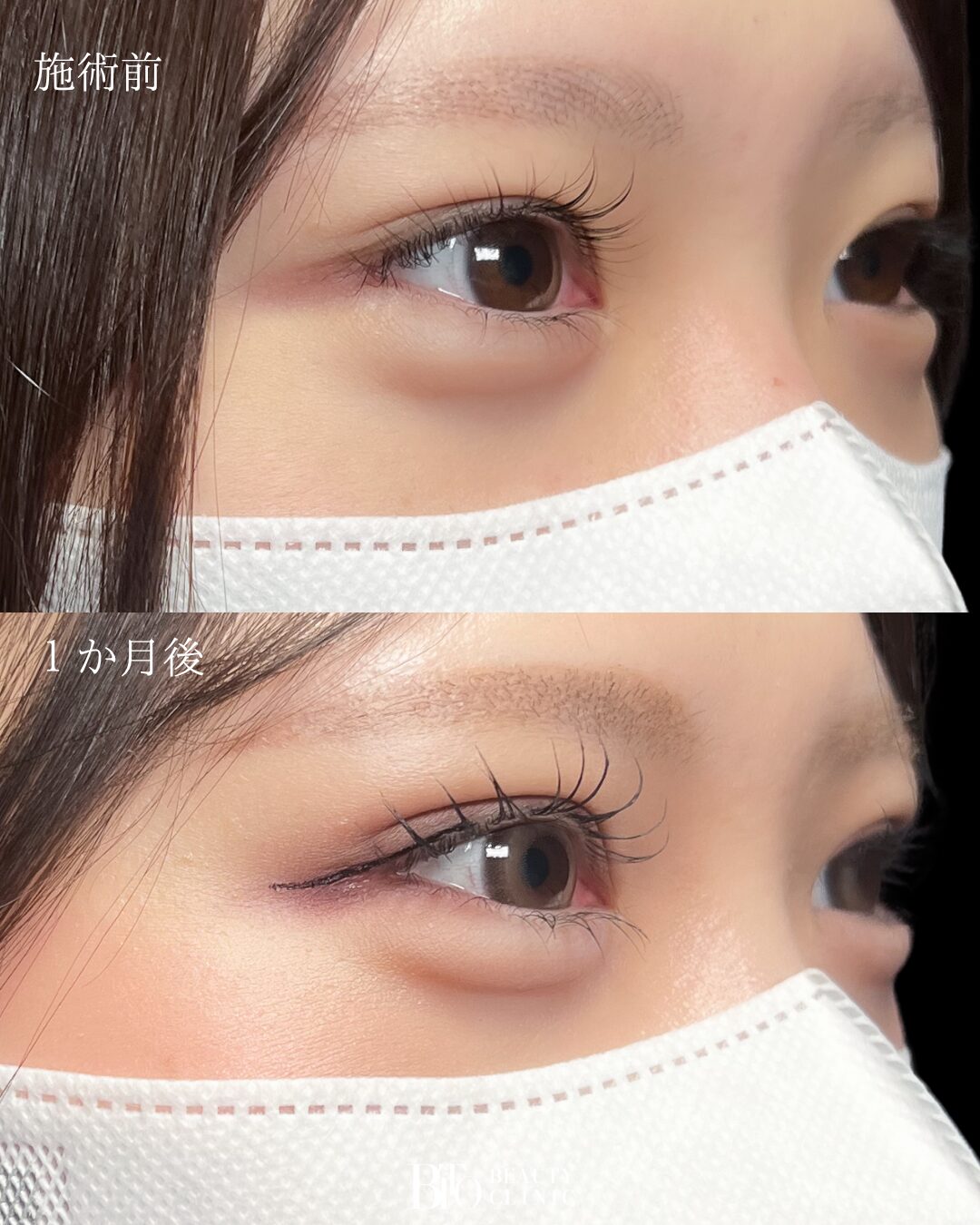 195.20代女性 二重埋没法