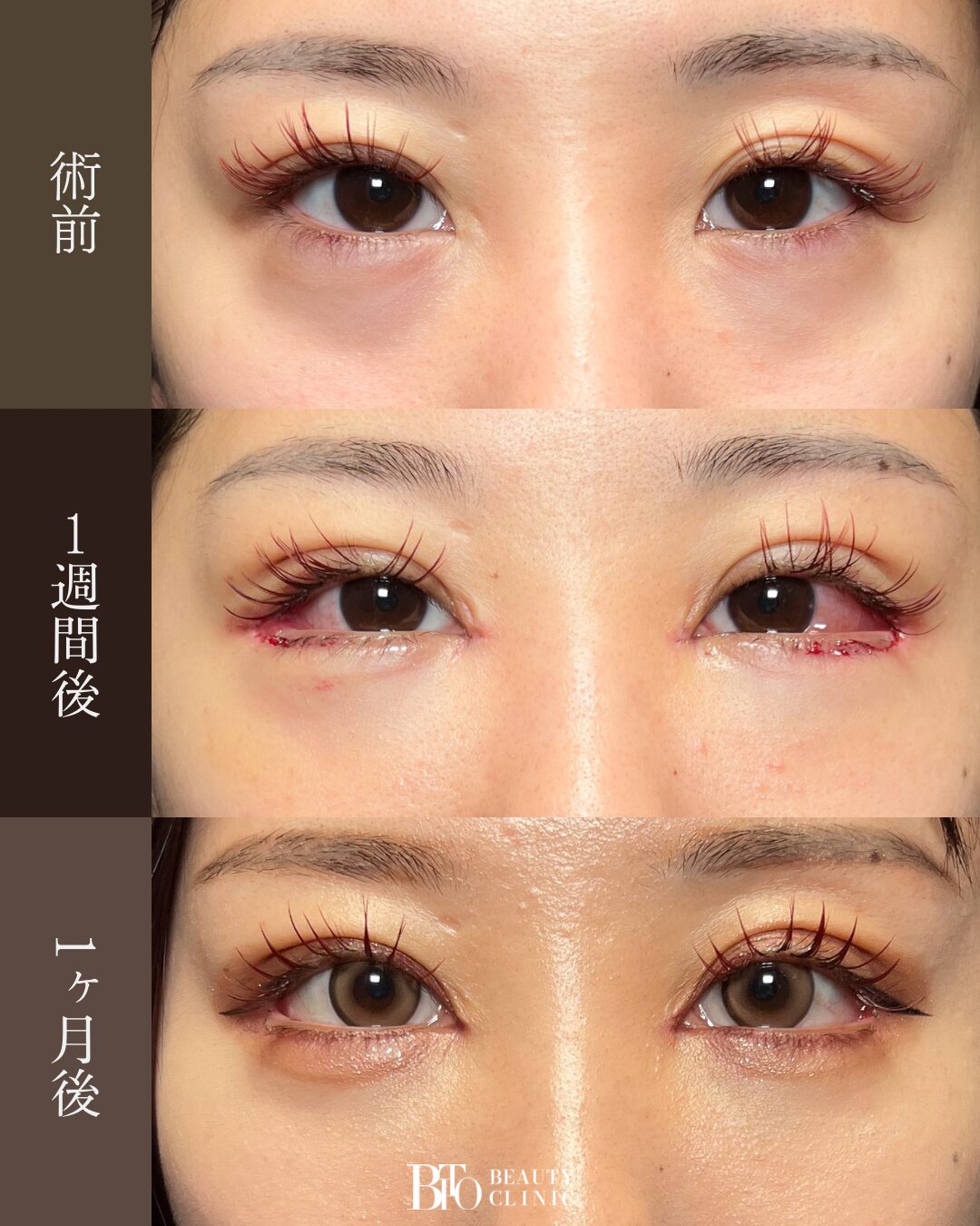 190. 目元フル整形