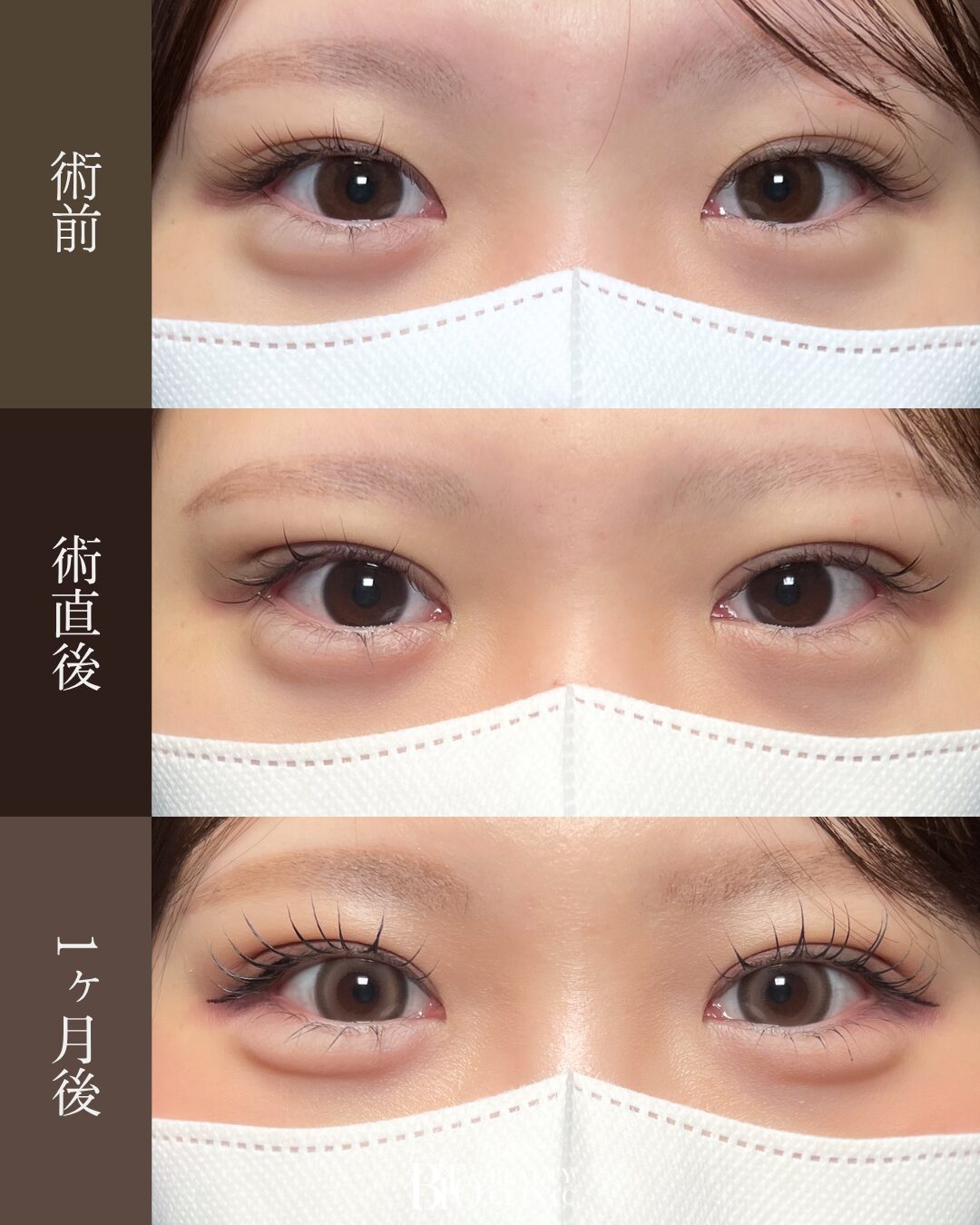 195.20代女性 二重埋没法